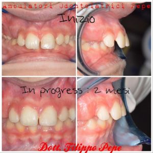 Ortodonzia intercettiva nel bambino